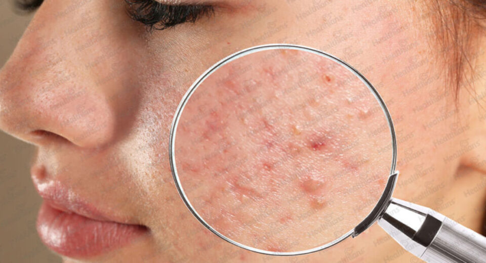 Skin issues: Understanding and Overcoming Common Skin Challenges